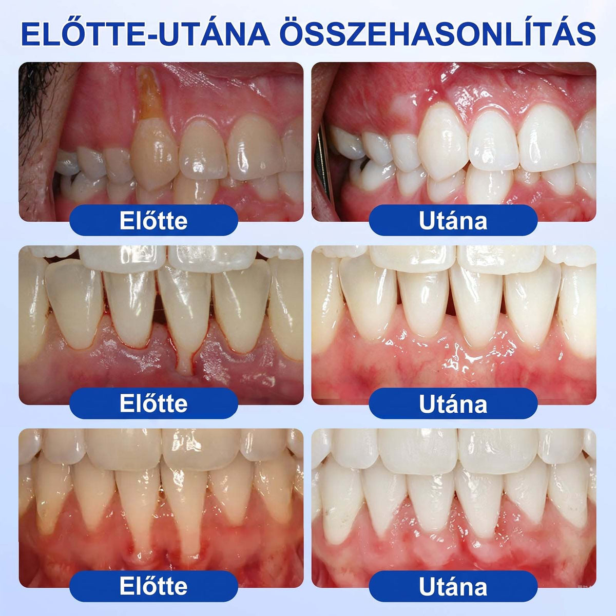 💓PureShade® 🦷 GumRevive Ínyregeneráló Gél – Az egészségesebb ínyért és magabiztosabb mosolyért 👍