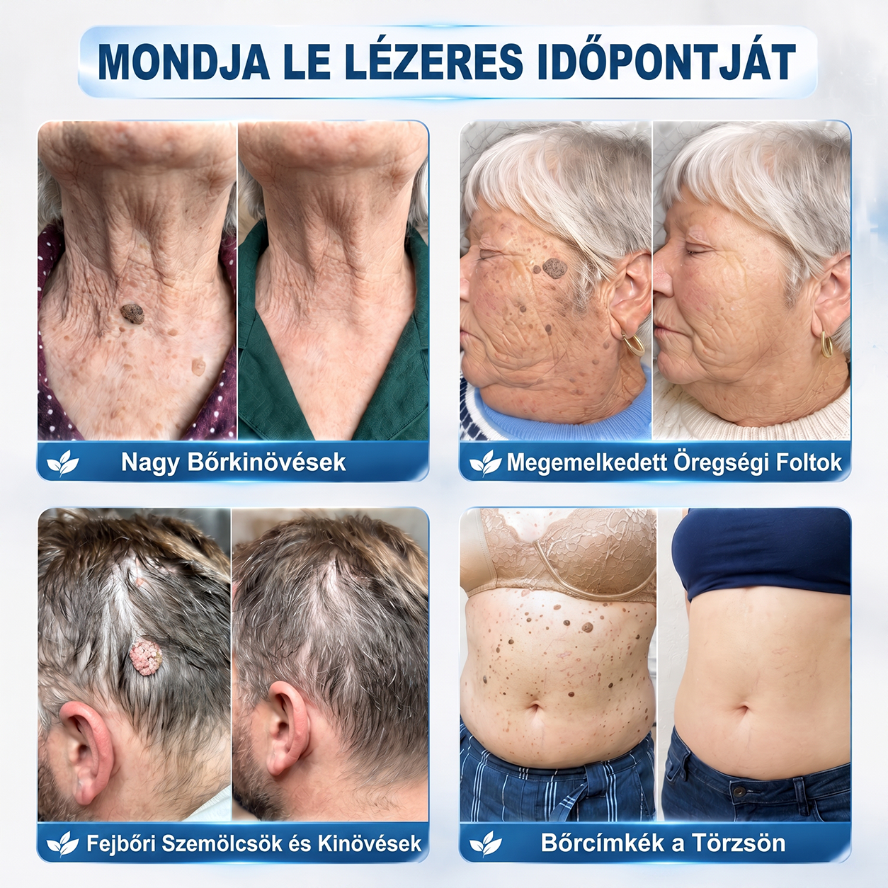 Hivatalos Márkabolt | 💓 Hiskin® 7 napos Szemölcseltávolító Roll-on Ápoló Folyadék (Fájdalommentes rollerball technológia, hegek nélkül) 🐬