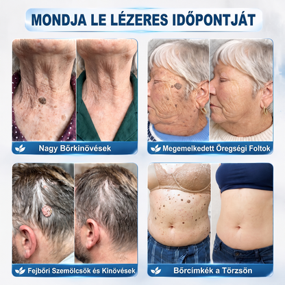 Hivatalos Márkabolt | 💓 Hiskin® 7 napos Szemölcseltávolító Roll-on Ápoló Folyadék (Fájdalommentes rollerball technológia, hegek nélkül) 🐬