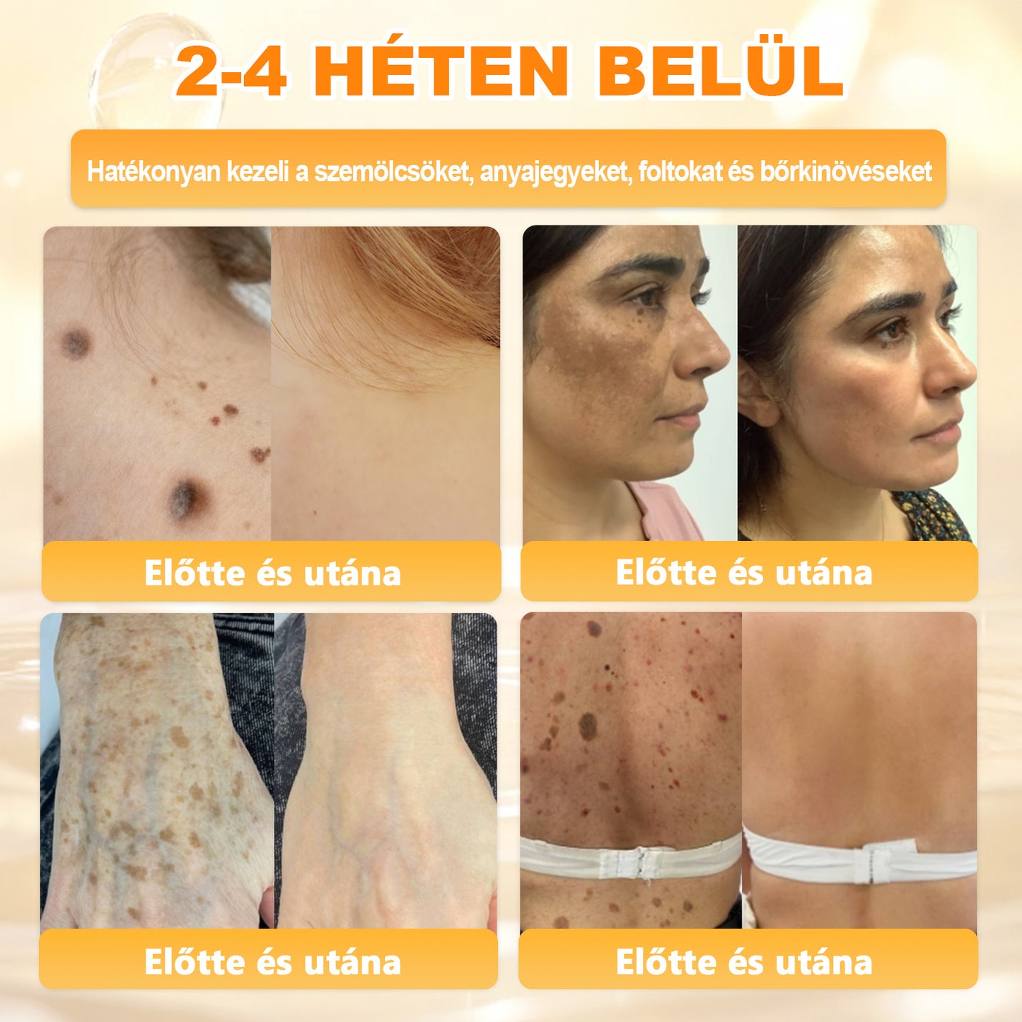 💜APKAPK® 𝐌É𝐇𝐌É𝐑𝐄𝐆 Á𝐓𝐅𝐎𝐆Ó 𝐊𝐑É𝐌𝐀 💛bőrnövedékek 𝐤𝐞𝐳𝐞𝐥é𝐬𝐞 𝐦𝐚𝐠á𝐛𝐚𝐧 𝐟𝐨𝐠𝐥𝐚𝐥𝐣𝐚: é𝐥𝐞𝐭𝐤𝐨𝐫𝐢 𝐟𝐨𝐥𝐭𝐨𝐤, 𝐡𝐞𝐠𝐞𝐤, 𝐬𝐳𝐞𝐦ö𝐥𝐜𝐬ö𝐤, 𝐛ö𝐫𝐧ö𝐯𝐞𝐝é𝐤𝐞𝐤, 𝐭á𝐥𝐲𝐨𝐠𝐨𝐤, 𝐩𝐚𝐭𝐭𝐚𝐧á𝐬𝐨𝐤, 𝐞𝐤𝐜é𝐦𝐚, 𝐩𝐬𝐨𝐫𝐢𝐚𝐬𝐢𝐬, 𝐚𝐜𝐧𝐞 𝐢𝐧𝐯𝐞𝐫𝐬𝐚, 𝐫á𝐧𝐜𝐨𝐤, 𝐛ö𝐫ö𝐫𝐞𝐠𝐞𝐝é𝐬 é𝐬 𝐞𝐠𝐲é𝐛 𝐩𝐫𝐨𝐛𝐥é𝐦á𝐤🔥