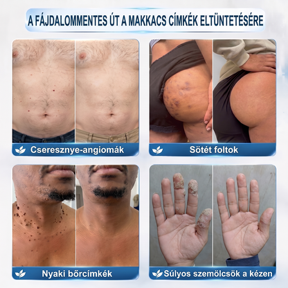 Hivatalos Márkabolt | 💓 Hiskin® 7 napos Szemölcseltávolító Roll-on Ápoló Folyadék (Fájdalommentes rollerball technológia, hegek nélkül) 🐬