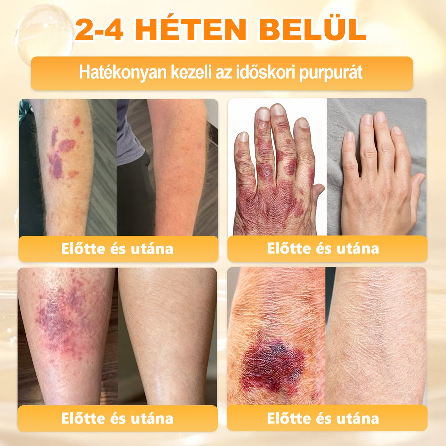 💜APKAPK® 𝐌É𝐇𝐌É𝐑𝐄𝐆 Á𝐓𝐅𝐎𝐆Ó 𝐊𝐑É𝐌𝐀 💛bőrnövedékek 𝐤𝐞𝐳𝐞𝐥é𝐬𝐞 𝐦𝐚𝐠á𝐛𝐚𝐧 𝐟𝐨𝐠𝐥𝐚𝐥𝐣𝐚: é𝐥𝐞𝐭𝐤𝐨𝐫𝐢 𝐟𝐨𝐥𝐭𝐨𝐤, 𝐡𝐞𝐠𝐞𝐤, 𝐬𝐳𝐞𝐦ö𝐥𝐜𝐬ö𝐤, 𝐛ö𝐫𝐧ö𝐯𝐞𝐝é𝐤𝐞𝐤, 𝐭á𝐥𝐲𝐨𝐠𝐨𝐤, 𝐩𝐚𝐭𝐭𝐚𝐧á𝐬𝐨𝐤, 𝐞𝐤𝐜é𝐦𝐚, 𝐩𝐬𝐨𝐫𝐢𝐚𝐬𝐢𝐬, 𝐚𝐜𝐧𝐞 𝐢𝐧𝐯𝐞𝐫𝐬𝐚, 𝐫á𝐧𝐜𝐨𝐤, 𝐛ö𝐫ö𝐫𝐞𝐠𝐞𝐝é𝐬 é𝐬 𝐞𝐠𝐲é𝐛 𝐩𝐫𝐨𝐛𝐥é𝐦á𝐤🔥