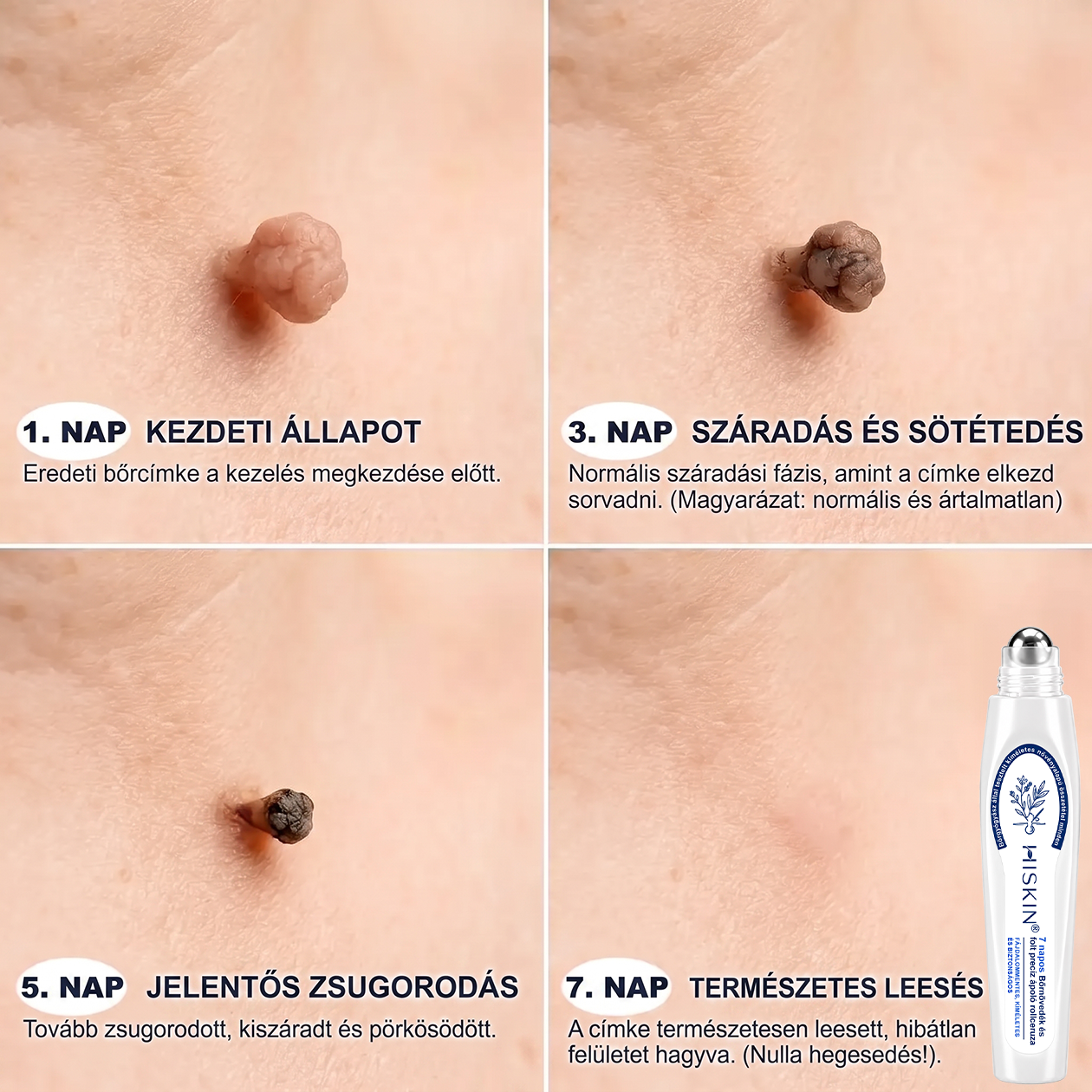 Hivatalos Márkabolt | 💓 Hiskin® 7 napos Szemölcseltávolító Roll-on Ápoló Folyadék (Fájdalommentes rollerball technológia, hegek nélkül) 🐬