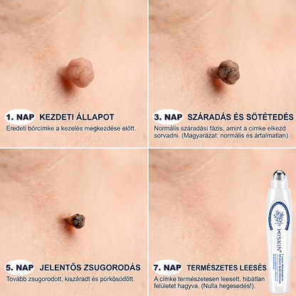 Hivatalos Márkabolt | 💓 Hiskin® 7 napos Szemölcseltávolító Roll-on Ápoló Folyadék (Fájdalommentes rollerball technológia, hegek nélkül) 🐬