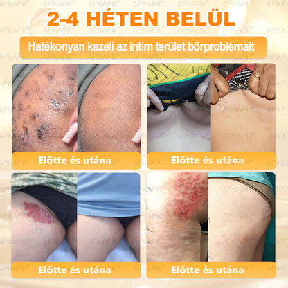 💜APKAPK® 𝐌É𝐇𝐌É𝐑𝐄𝐆 Á𝐓𝐅𝐎𝐆Ó 𝐊𝐑É𝐌𝐀 💛bőrnövedékek 𝐤𝐞𝐳𝐞𝐥é𝐬𝐞 𝐦𝐚𝐠á𝐛𝐚𝐧 𝐟𝐨𝐠𝐥𝐚𝐥𝐣𝐚: é𝐥𝐞𝐭𝐤𝐨𝐫𝐢 𝐟𝐨𝐥𝐭𝐨𝐤, 𝐡𝐞𝐠𝐞𝐤, 𝐬𝐳𝐞𝐦ö𝐥𝐜𝐬ö𝐤, 𝐛ö𝐫𝐧ö𝐯𝐞𝐝é𝐤𝐞𝐤, 𝐭á𝐥𝐲𝐨𝐠𝐨𝐤, 𝐩𝐚𝐭𝐭𝐚𝐧á𝐬𝐨𝐤, 𝐞𝐤𝐜é𝐦𝐚, 𝐩𝐬𝐨𝐫𝐢𝐚𝐬𝐢𝐬, 𝐚𝐜𝐧𝐞 𝐢𝐧𝐯𝐞𝐫𝐬𝐚, 𝐫á𝐧𝐜𝐨𝐤, 𝐛ö𝐫ö𝐫𝐞𝐠𝐞𝐝é𝐬 é𝐬 𝐞𝐠𝐲é𝐛 𝐩𝐫𝐨𝐛𝐥é𝐦á𝐤🔥