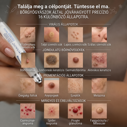 Hivatalos Márkabolt | 💓 Hiskin® 7 napos Szemölcseltávolító Roll-on Ápoló Folyadék (Fájdalommentes rollerball technológia, hegek nélkül) 🐬