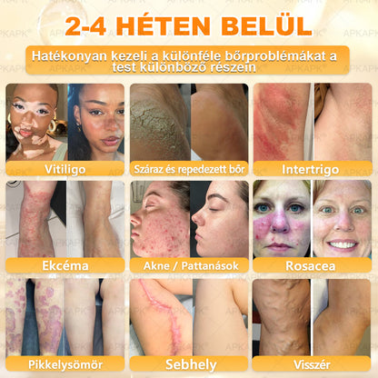 💜APKAPK® 𝐌É𝐇𝐌É𝐑𝐄𝐆 Á𝐓𝐅𝐎𝐆Ó 𝐊𝐑É𝐌𝐀 💛bőrnövedékek 𝐤𝐞𝐳𝐞𝐥é𝐬𝐞 𝐦𝐚𝐠á𝐛𝐚𝐧 𝐟𝐨𝐠𝐥𝐚𝐥𝐣𝐚: é𝐥𝐞𝐭𝐤𝐨𝐫𝐢 𝐟𝐨𝐥𝐭𝐨𝐤, 𝐡𝐞𝐠𝐞𝐤, 𝐬𝐳𝐞𝐦ö𝐥𝐜𝐬ö𝐤, 𝐛ö𝐫𝐧ö𝐯𝐞𝐝é𝐤𝐞𝐤, 𝐭á𝐥𝐲𝐨𝐠𝐨𝐤, 𝐩𝐚𝐭𝐭𝐚𝐧á𝐬𝐨𝐤, 𝐞𝐤𝐜é𝐦𝐚, 𝐩𝐬𝐨𝐫𝐢𝐚𝐬𝐢𝐬, 𝐚𝐜𝐧𝐞 𝐢𝐧𝐯𝐞𝐫𝐬𝐚, 𝐫á𝐧𝐜𝐨𝐤, 𝐛ö𝐫ö𝐫𝐞𝐠𝐞𝐝é𝐬 é𝐬 𝐞𝐠𝐲é𝐛 𝐩𝐫𝐨𝐛𝐥é𝐦á𝐤🔥