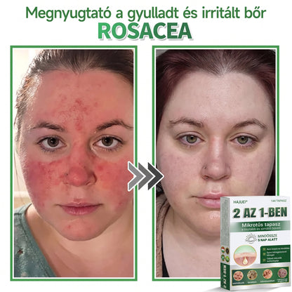 🇭🇺HAJUEI® ☺️ 2-az-1-ben Mikrotű & Hidrokoloid Tapasz | 🧪 Kiemelkedő Anyajegyek, Pattanások, Lapos Szemölcsök & Bőrkinövések Eltávolítója | Ráncok, Hegek & Bőrhibák Javítása | Láthatatlan Csillag Pattanástapasz Arcra & Testre | 144 db ✨