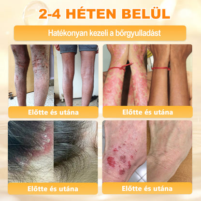 💜APKAPK® 𝐌É𝐇𝐌É𝐑𝐄𝐆 Á𝐓𝐅𝐎𝐆Ó 𝐊𝐑É𝐌𝐀 💛bőrnövedékek 𝐤𝐞𝐳𝐞𝐥é𝐬𝐞 𝐦𝐚𝐠á𝐛𝐚𝐧 𝐟𝐨𝐠𝐥𝐚𝐥𝐣𝐚: é𝐥𝐞𝐭𝐤𝐨𝐫𝐢 𝐟𝐨𝐥𝐭𝐨𝐤, 𝐡𝐞𝐠𝐞𝐤, 𝐬𝐳𝐞𝐦ö𝐥𝐜𝐬ö𝐤, 𝐛ö𝐫𝐧ö𝐯𝐞𝐝é𝐤𝐞𝐤, 𝐭á𝐥𝐲𝐨𝐠𝐨𝐤, 𝐩𝐚𝐭𝐭𝐚𝐧á𝐬𝐨𝐤, 𝐞𝐤𝐜é𝐦𝐚, 𝐩𝐬𝐨𝐫𝐢𝐚𝐬𝐢𝐬, 𝐚𝐜𝐧𝐞 𝐢𝐧𝐯𝐞𝐫𝐬𝐚, 𝐫á𝐧𝐜𝐨𝐤, 𝐛ö𝐫ö𝐫𝐞𝐠𝐞𝐝é𝐬 é𝐬 𝐞𝐠𝐲é𝐛 𝐩𝐫𝐨𝐛𝐥é𝐦á𝐤🔥